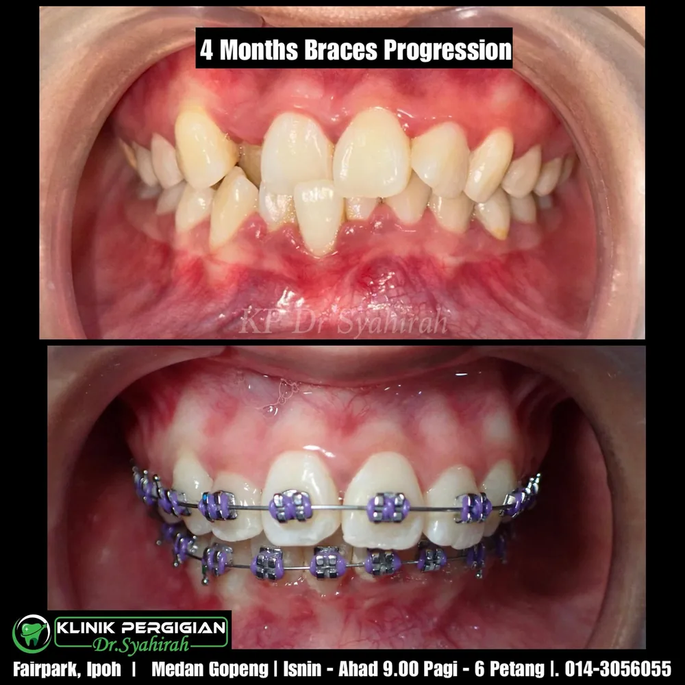 Braces / ortodontik